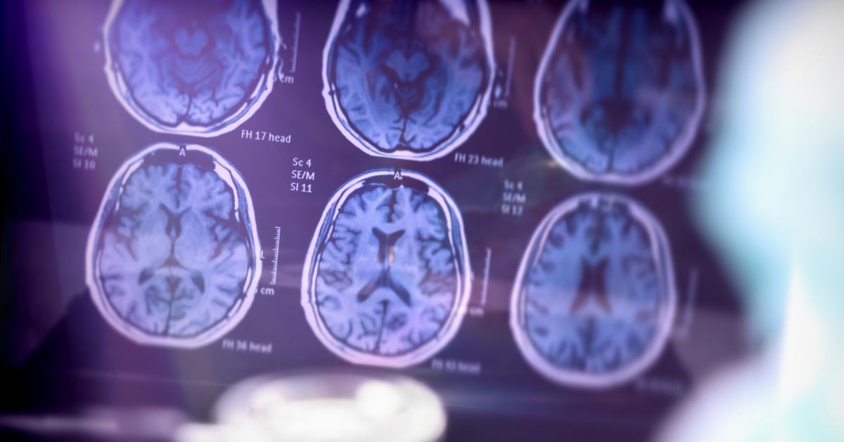 Alzheimers – ett genombrott